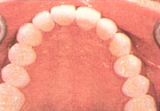 Figure 14. Posts operative occlusal view of maxilary arch