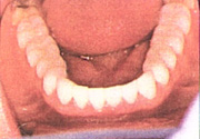 Figurer 15. Postoperative occlusal view of mandibular arch