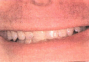 Figure 2. Preoperative Smile