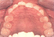 Figure 5. Preoperative maxillary occlusal view