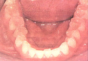 Figure 6. Preoperative mandibular occlusal view