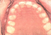 Figure 7. Occlusal view of preparations