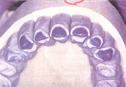Figure 8. Cas of maxilary preparations