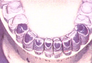 Figure 9. Cas of mandibular preparations